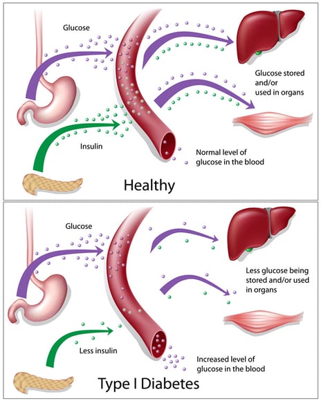 diabetes-type-1